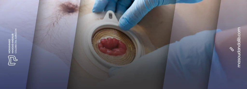 جراحی سرپایی کولون؛ درمان کمتهاجمی بیماریهای روده بزرگ 12 Outpatient colon surgery 1