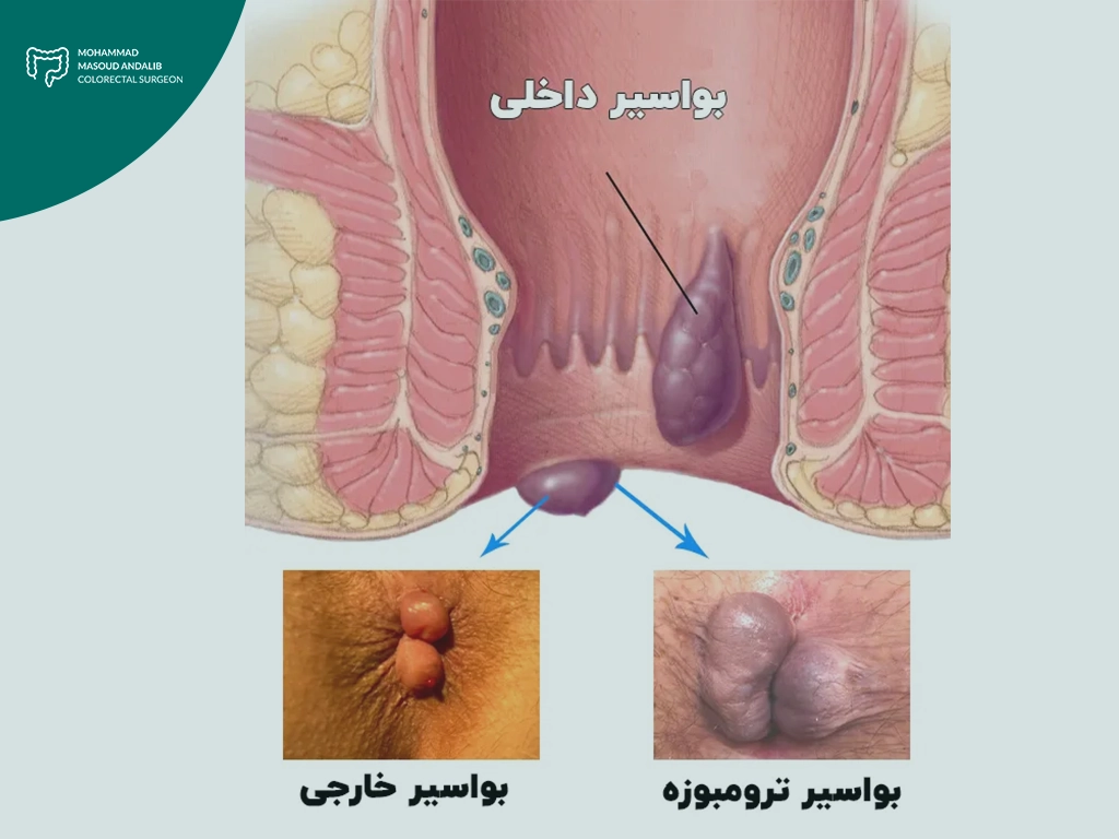 بواسیر در زنان و مردان؛ علتها، علائم و مؤثرترین راهکارهای درمان 1 بواسیر در زنان و مردان