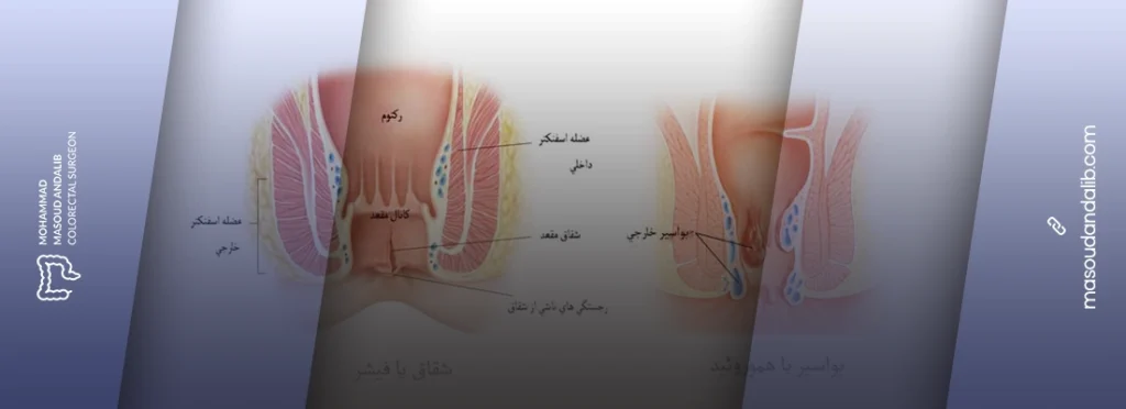 تفاوت بواسیر و شقاق؛ مقایسه علائم، علتها و روشهای درمان هر کدام 8 تفاوت بواسیر و شقاق